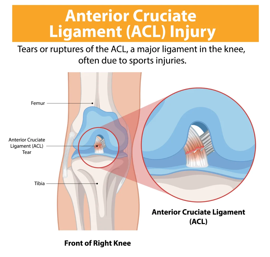 acl reconstruction surgery in indore, acl surgery in indore, acl tear surgery in indore, acl knee arthroscopy in indore,