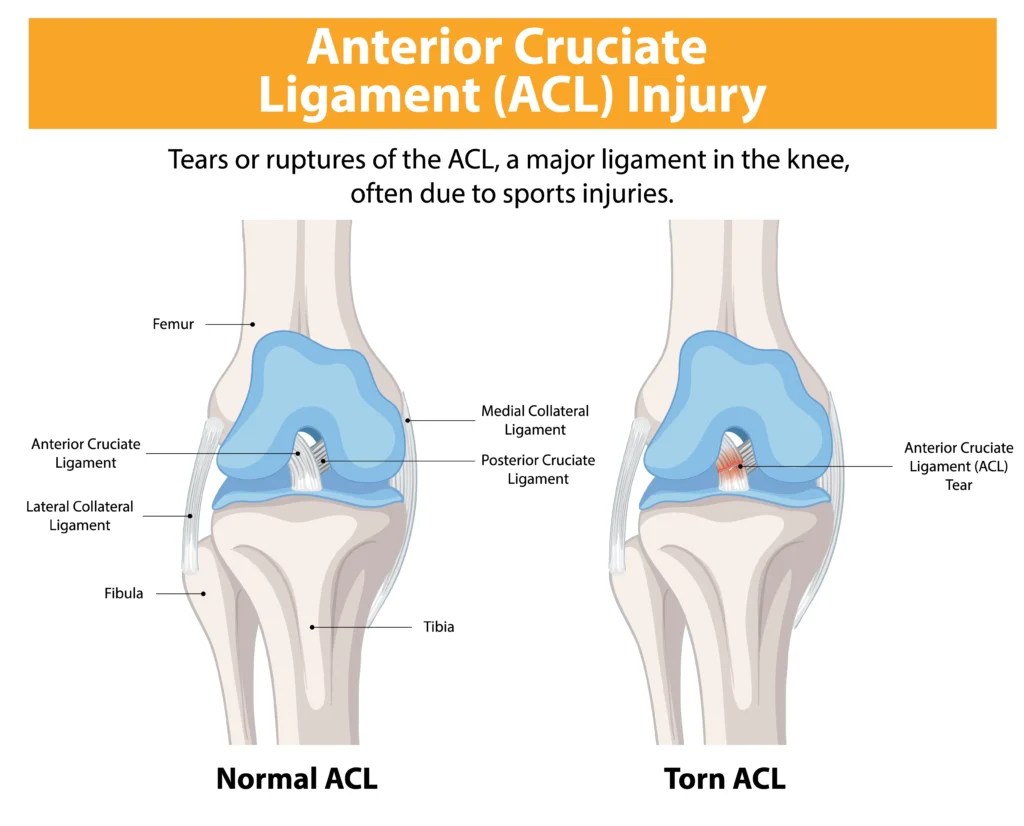 acl reconstruction surgery in indore, acl surgery in indore, acl tear surgery in indore