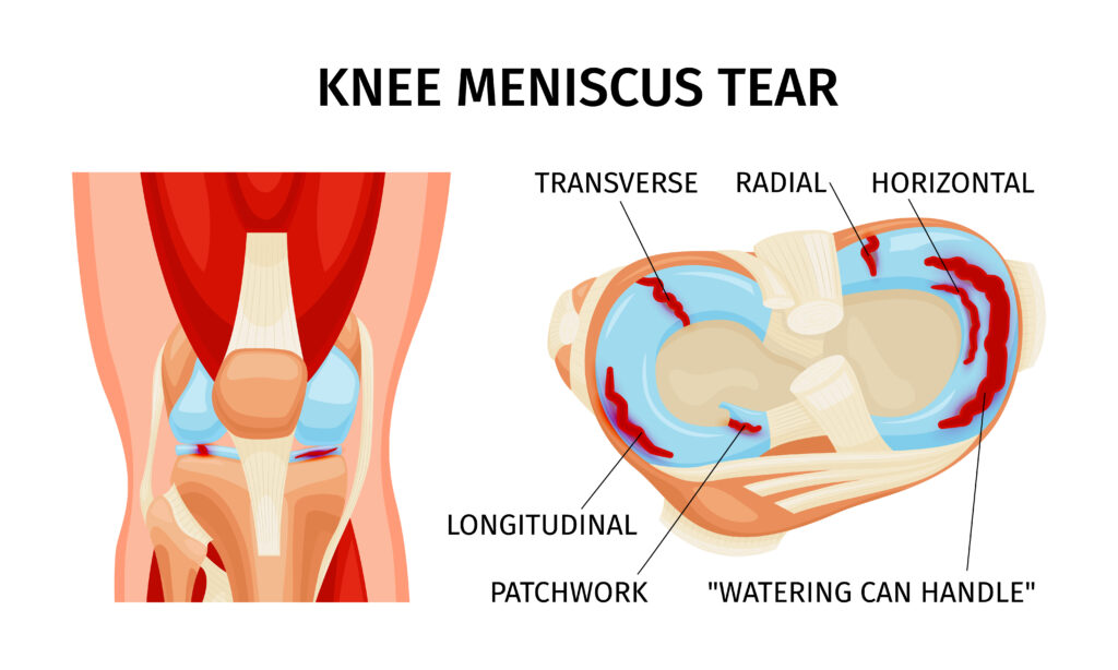 best meniscus repair in indore, meniscus knee arthroscopy in indore, meniscus repair arthroscopic in indore, meniscus tears treatment in indore