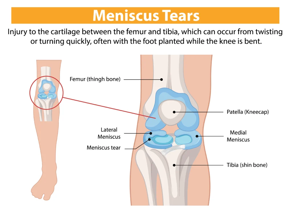 meniscus repair surgery in indore, meniscus tear surgery in indore, arthroscopy meniscus surgery in indore