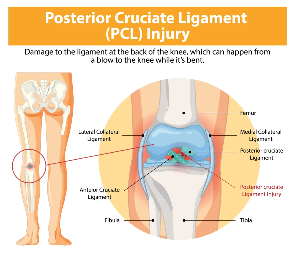 pcl reconstruction surgery in indore, pcl surgery in indore