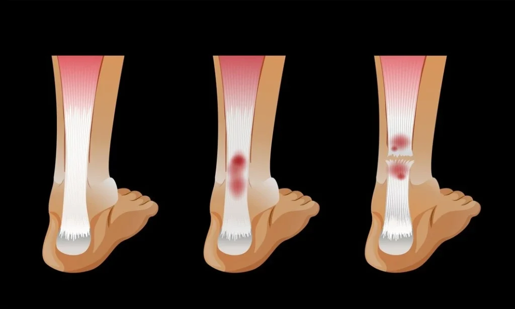 Ankle Surgery in Indore, orthopedic doctor in indore, best orthopedic doctor in indore